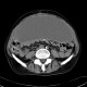 Peritoneal dialysis, complication, fluid collection, gigantic, after: CT - Computed tomography